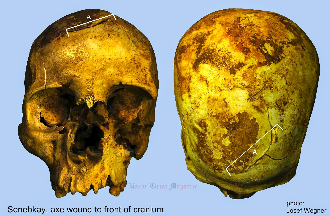 Раны на передней части черепа Сенебкая, нанесенные топором.