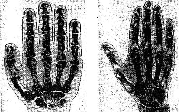 Кисть руки неандертальца из Киик-Кобы (реконструкция) и рентгенограмма кисти руки современного человека