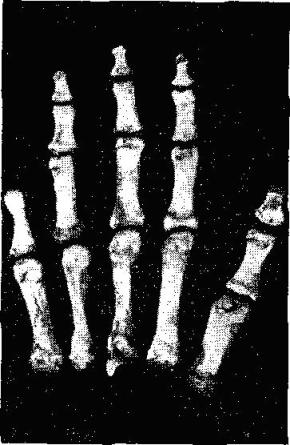 Кости правой руки кисти женщины эпохи мезолита с ампутированной фалангой мизинца